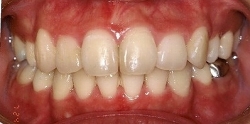 乱杭歯　治療例4のイメージ