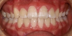 すきっ歯　治療例3のイメージ